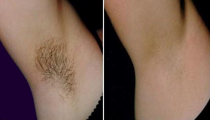 IPL and Electrolysis Hair Removal Stoke on Trent | Swann ...