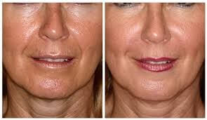 Skin Deep Laser Med Spa Reviews Skin Deep Laser Med Spa Reviews