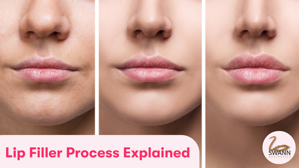 Three images side-by-side, showing the difference that lip filler makes. From left to right, there is a before image, an image with a small amount of filler, and the final result with more lip filler.